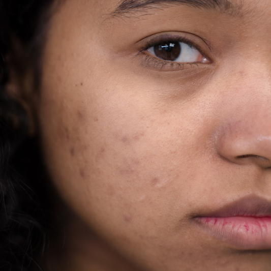 A Simple Guide to Acne Care: Embracing Skinimalism for Clearer Skin